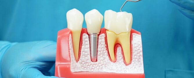 Dantura completă pe implant